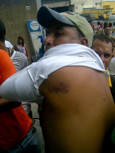 Reinaldo Villasmil, trabajador de Souto, muestra los moretones en la espalda de los golpes a palo que recibió