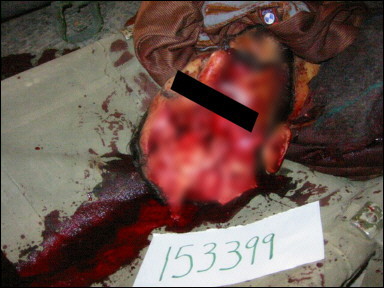 Foto difundida el 15 de febrero de 2006 por la cadena de televisión australiana SBS, que afirma que se trata de un prisionero iraquí con graves heridas en la cabeza sufridas en la cárcel de Abu Ghraib, bajo control estadounidense