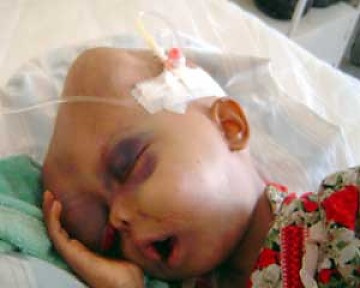 Niños en Basora, Irak, nacieron con cáncer y deformaciones debido a la presencia de uranio empobrecido usado por Estados Unidos en municiones convencionales y blindajes de tanques.