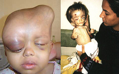 niños víctimas del uranio empobrecido.