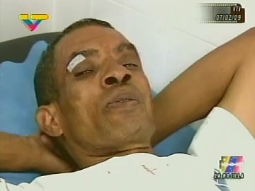 El conductor del autobús agredido, tuvo que recibir puntos de sutura en la ceja derecha tras la brutal golpiza.