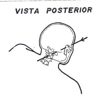 Trayectoria Intraorgánica de Erasmo Sánchez que ilustra el recorrido del proyectil según lo describe el Protocolo de Autopsia Nº 102468