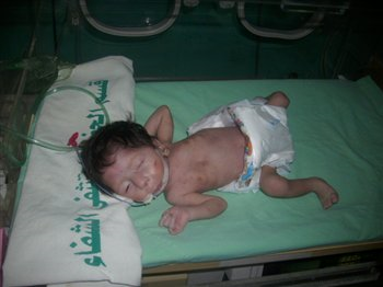 bebés nacidos con malformaciones en Gaza