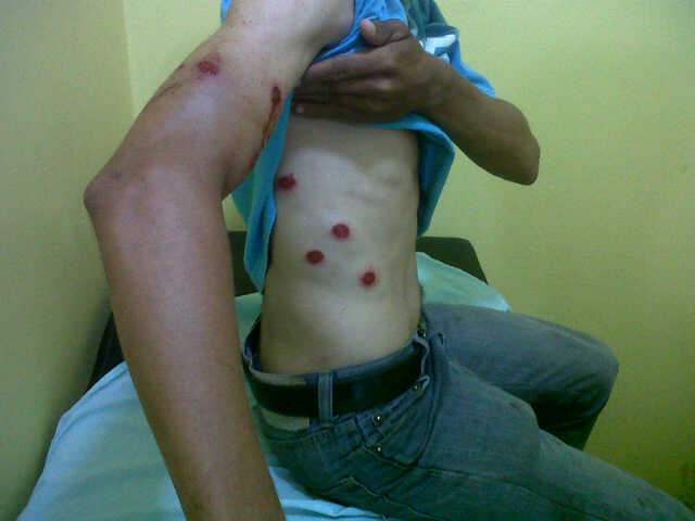 Campesino herido por funcionarios de la policía de Colón, Zulia