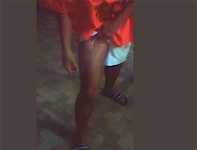 Un inmigrante venezolano detenido en Trinidad muestra una de sus piernas con cortaduras autoinfligidas