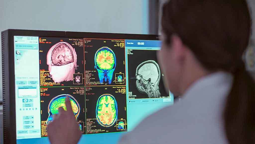 Oncologos enfrentan con efectividad tumores cerebrales