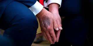 En varias imágenes se han visto morados en las manos de Donald Trump